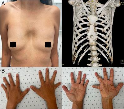 Case report: Craniofrontonasal syndrome caused by a novel variant in the EFNB1 gene in a Colombian woman